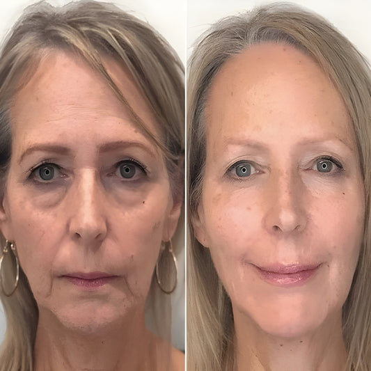 Instant Eye Lift™ | 1+1 GRATIS