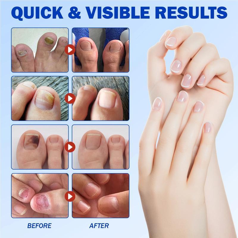 ClearNail™ | Overnight Nail Repair Patches | 1 + 1 GRATIS