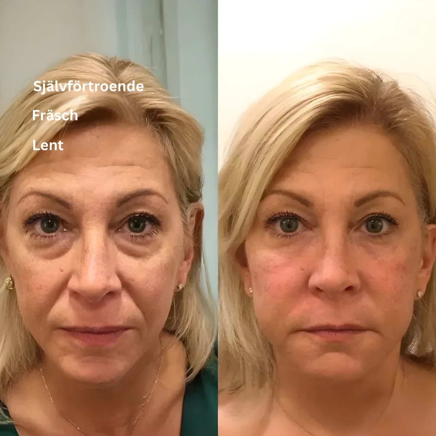 Elira™ | Instant Eye Smooth Lift | 1 + 1  GRATIS