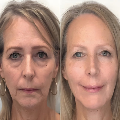 Instant Eye Lift™ | 1+1 GRATIS